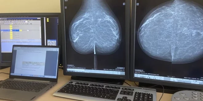 мамографија мамограф